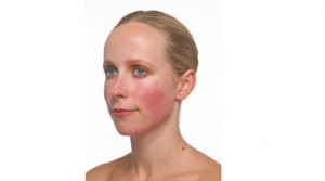 Rosacea